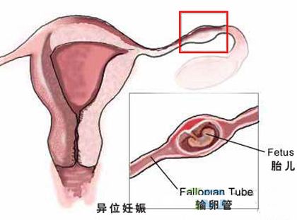 俄罗斯试管婴儿